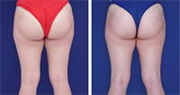 Tratamiento en glúteos con CoreSculpt