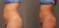 Tratamiento en abdomen con LIPOcel