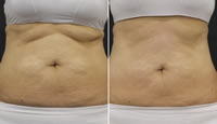 Tratamiento en Abdomen con Noble SHAPE