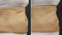 Tratamiento en Abdomen con Noble SHAPE