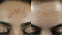 Tratamiento de melasma en la frente con TRI-BEAM Premium