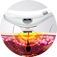 Depilación con Cellec V