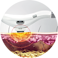 Tratamiento de pigmentaciones con Cellec V
