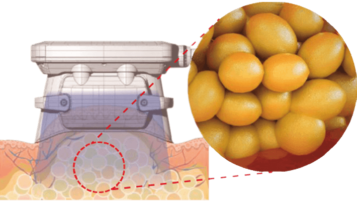 Crío-enfriamineto con COOLshaping