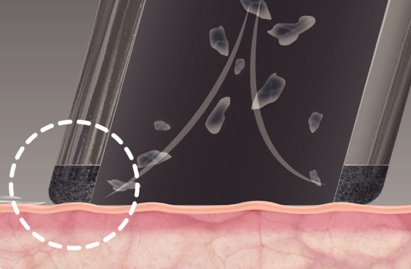 Peeling de Diamante función