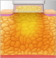 Aplicación de calor con LIPO1060