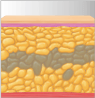 Destrucción de células grasas con LIPO1060