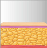 Adipositos eliminados con LIPO1060