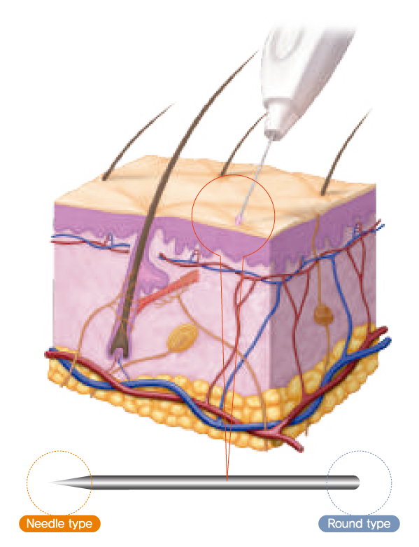 Irradiación de energía con ULTRAcel