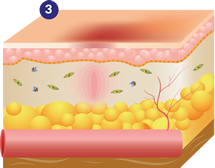 Fase de remodelación con ULTRAcel Q+