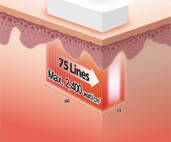 Depilación con VeLux